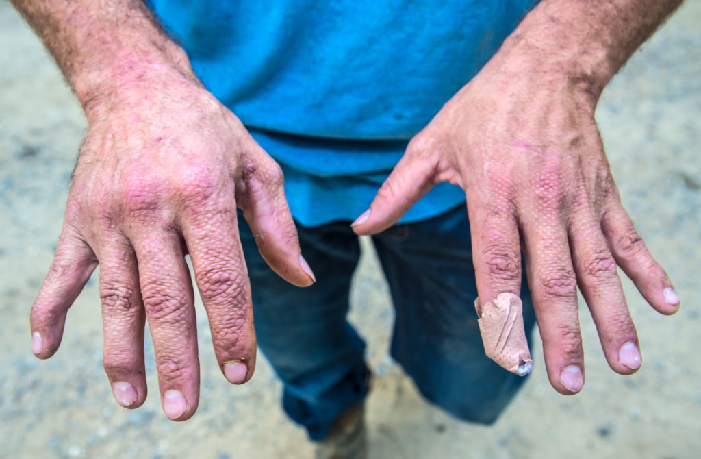 Bram Ates shows the skin grafts on the backs of his hands. Ates used his hands to shield his face when an explosion erupted at a VT Halter shipyard.Credit: Julie Dermansky for Reveal